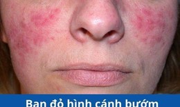 Bệnh lupus ban đỏ v&#224; c&#225;ch hỗ trợ giảm nguy cơ tiến triển từ thảo dược