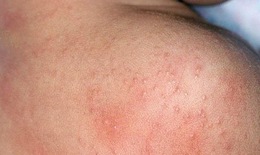 Bài thuốc đông y trị phát ban và rôm sảy