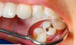 C&#225;c loại thuốc điều trị s&#226;u răng bạn cần biết