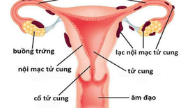 Thuốc giảm đau do lạc nội mạc tử cung ở phụ nữ tiền mãn kinh