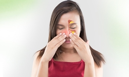 Điều trị viêm xoang, đừng vội dùng thuốc kháng sinh