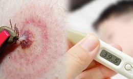 Liên tiếp các ca bệnh nhập viện do sốt mò, cần làm gì để phòng bệnh?