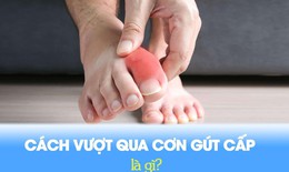 Giải pháp giúp giảm đau cơn gút cấp an toàn và hiệu quả