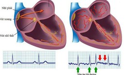 Triệu chứng cảnh báo 6 bệnh tim mạch thường gặp