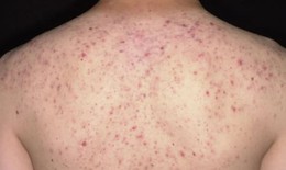 Người phụ nữ 36 tuổi suýt mất mạng vì đến spa trị mụn trứng cá ở lưng