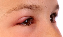 Mắt liên tục có gỉ là biểu hiện của bệnh gì?