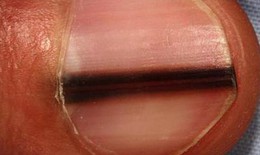 Dấu hiệu nhận biết ung thư tế bào hắc tố ở móng tay