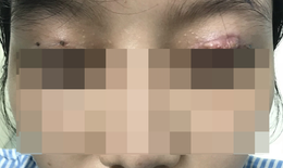 Cắt mí mắt ở cơ sở thẩm mỹ "chui", một phụ nữ bị hỏng mắt