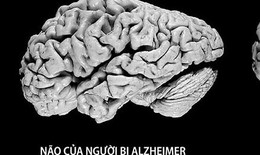 Thuốc mới điều trị bệnh Alzheimer