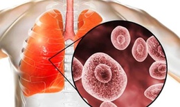 Yếu tố nguy cơ nhiễm nấm phổi do Aspergillus