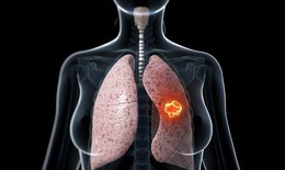 Biểu hiện sớm ung thư phổi ở giai đoạn đầu