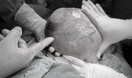 Phẫu thuật cắt bỏ khối u xơ nặng 3,5kg cho người phụ nữ dân tộc Dao
