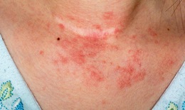 Nhận biết và xử trí khi bị viêm da atopy