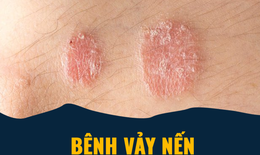 Điều trị vảy nến tr&#234;n bệnh nh&#226;n HIV - Những th&#244;ng tin khoa học