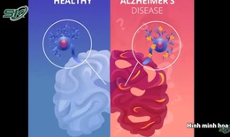 Cảnh báo: Bệnh Alzheimer trẻ hóa, nhiều người 30 tuổi đã lúc nhớ lúc quên