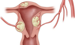 U xơ tử cung có nguy hiểm không và cách hỗ trợ từ thảo dược