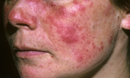 Lupus ban đỏ ảnh hưởng đến tuổi thọ như thế n&#224;o?