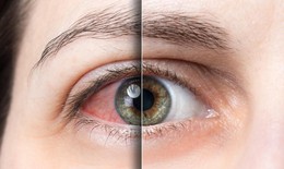 Nhận biết và điều trị khô mắt tránh suy giảm thị lực