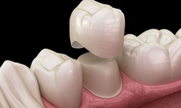 Bọc răng sứ, những cảnh báo đáng lưu ý