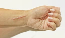 Điều trị sẹo - khi nào là thời điểm vàng?