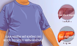 Bệnh gan nhiễm mỡ không do rượu có nguy hiểm không?