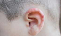 Đau rát một bên tai như bị bỏng, chảy nước… cảnh giác với zona tai