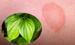 Trị hắc lào bằng thảo dược tại nhà