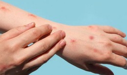 TPHCM: Ghi nhận 33 ca mắc đậu mùa khỉ, tất cả là nam giới