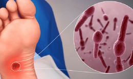 2 trường hợp tử vong do uốn v&#225;n, chuy&#234;n gia cảnh b&#225;o sự nguy hiểm của bệnh