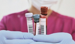 Acid uric bao nhiêu là cao? Lời khuyên cho người tăng acid uric máu