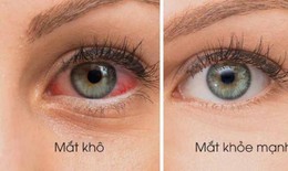 5 bài thuốc giúp giảm các triệu chứng khô mắt