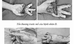 Xuyên đêm nối thành công 3 ngón tay bị đứt rời do tai nạn lao động