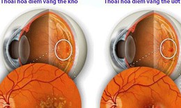 Ngăn thoái hóa điểm vàng ở người cao tuổi với 5 lưu ý sau