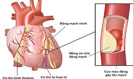 8 dấu hiệu của bệnh tim cần đi khám ngay