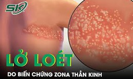 Lở loét khắp người do biến chứng của bệnh Zona thần kinh