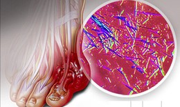Khi nào cần xét nghiệm acid uric?