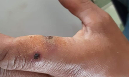 Lai Ch&#226;u: Khẩn trương kiểm so&#225;t, kh&#244;ng để dịch bệnh than l&#226;y lan tr&#234;n diện rộng