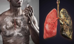 Những tiến bộ trong m&#244; h&#236;nh điều trị ung thư phổi