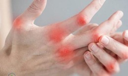 Bài thuốc đông y trị đau nhức khớp