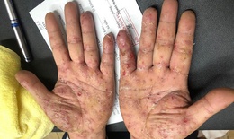 Nghĩ ngứa da do thời tiết, đi kh&#225;m cả nh&#224; ph&#225;t hiện mắc  ghẻ