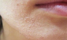 C&#225;ch gi&#250;p da khỏe mạnh, mềm mại trong m&#249;a đ&#244;ng