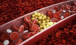 Ai có nguy cơ mắc cholesterol cao?