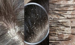 Giải pháp cho tình trạng gàu, nấm ngứa dai dẳng