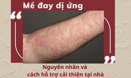 Mề đay dị ứng - Nguy&#234;n nh&#226;n v&#224; c&#225;ch hỗ trợ cải thiện tại nh&#224;