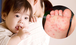 Trẻ vừa khỏi bệnh tay chân miệng vẫn có nguy cơ mắc lại nếu tiếp xúc với nguồn lây