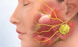 Quản lý bệnh phổi ở người mắc hội chứng Sjögren