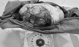 Giải thoát cô gái 28 tuổi khỏi khối u buồng trứng khổng lồ, nặng 6,5kg