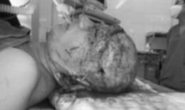 Phẫu thuật thành công cho nữ công nhân bị quấn tóc vào máy khiến toàn bộ da đầu bị giật đứt rời
