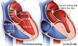 Bệnh cơ tim: Nguyên nhân, triệu chứng và cách điều trị
