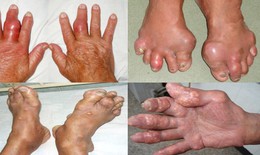 Bệnh gout và những biến chứng nguy hiểm mà nhiều người chưa biết